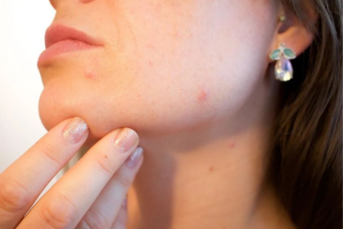 Receitas caseiras INFALÍVEIS para acabar com as acnes e espinhas