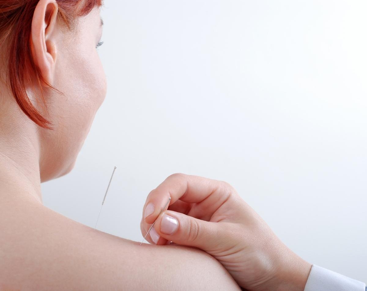 Acupuntura: conheça benefícios poderosos desta prática milenar - foto: Canva