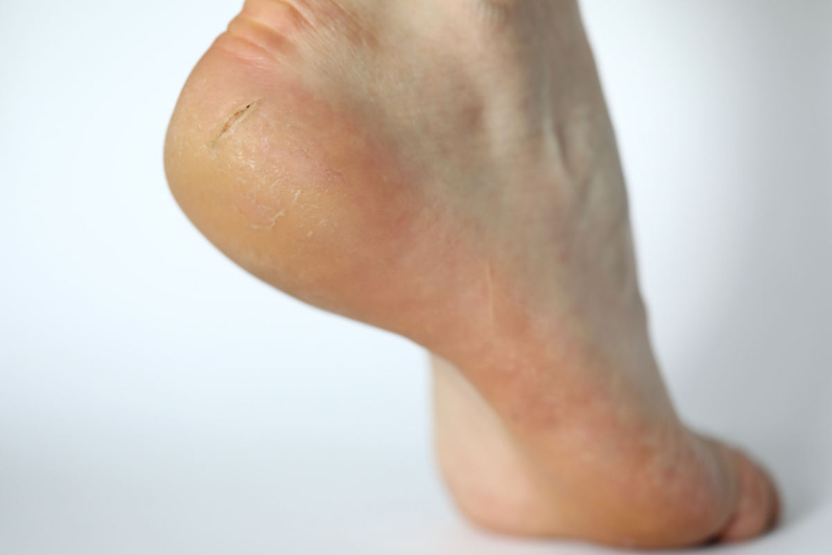 Saiba dicas para acabar com pés ressecados e rachados - Reprodução Canva