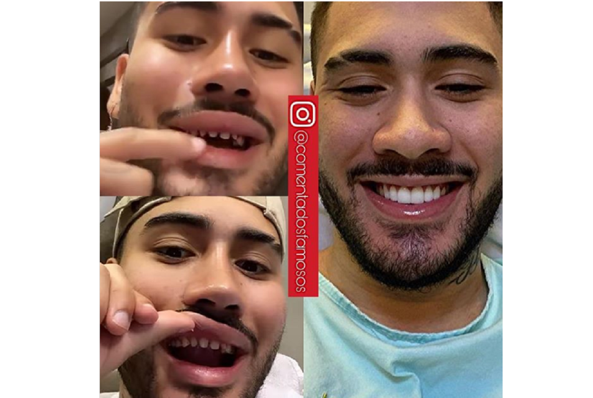 Imagem: Cantor Kevinho exibe desgaste causado pa a colocação das lentes de contato dentais (Reprodução/Instagram)