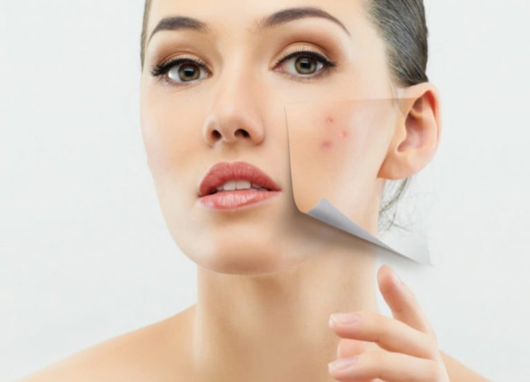 Acne nas mulheres adultas: como lidar com isso e dicas para manter a autoestima