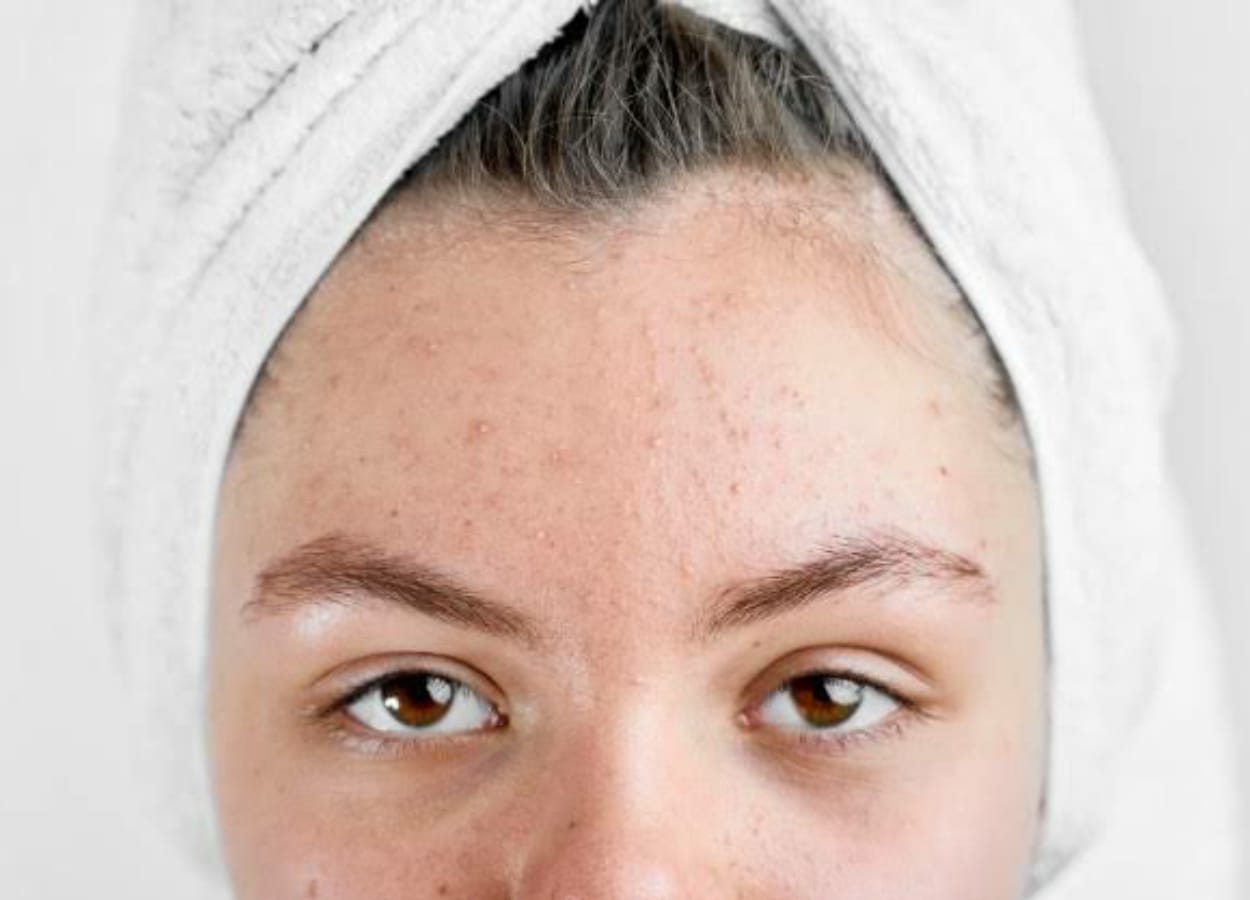 Boa parte das mulheres sofre de acne em algum momento de suas vidas