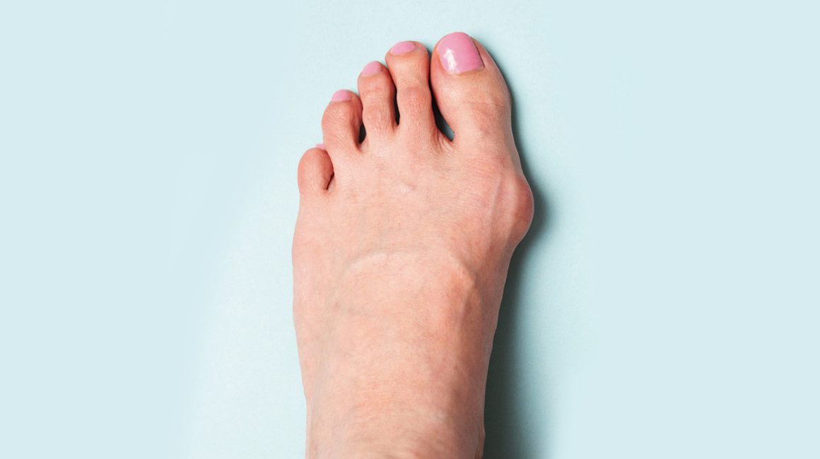 5 dicas de sapato para quem tem joanete: veja como escolher e descanse seus  pés